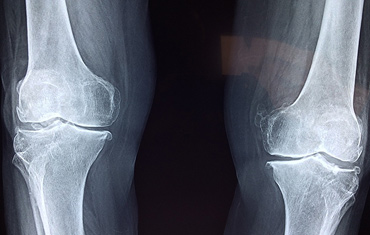 ACL Surgery vs Total Knee Replacement Surgery